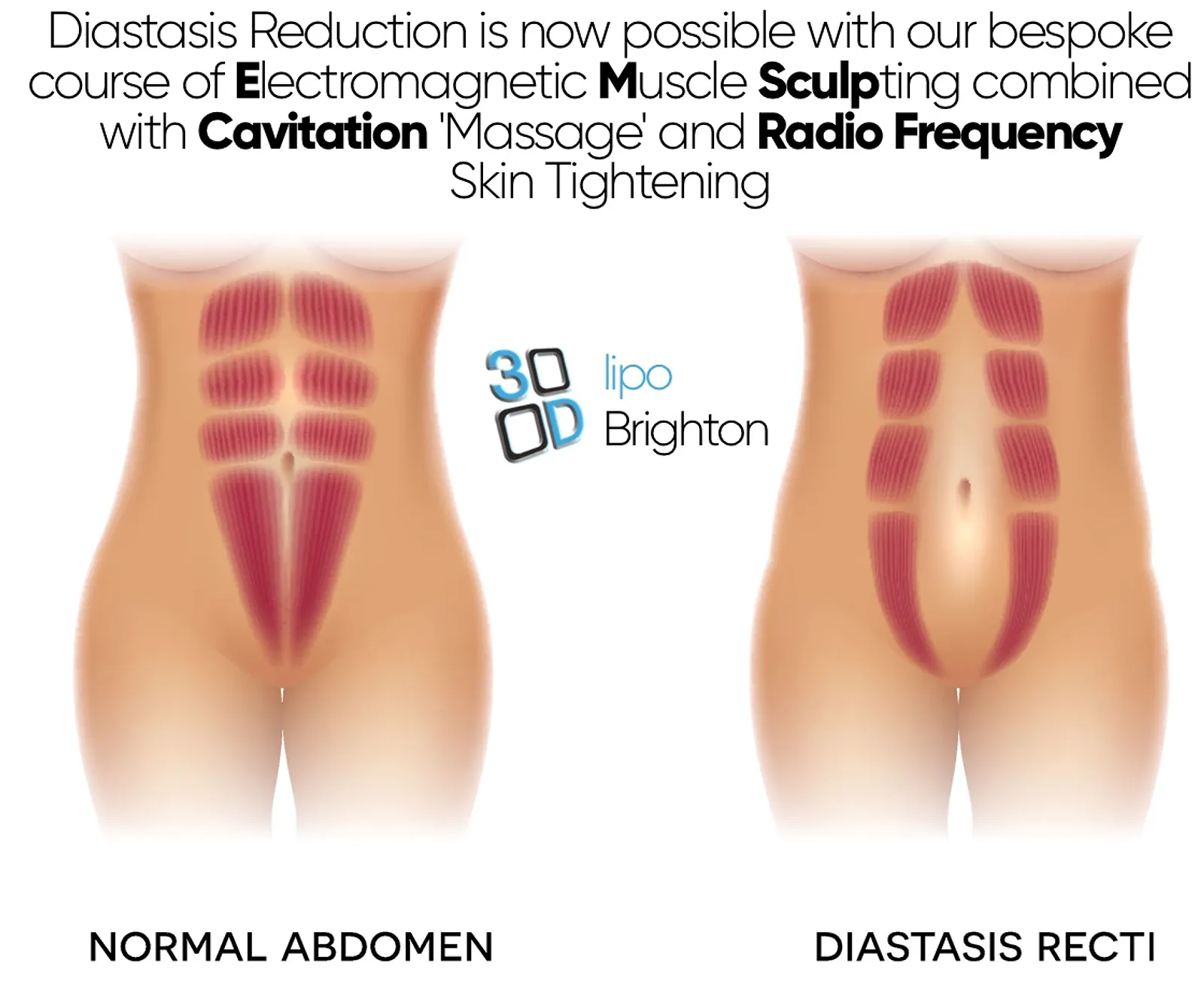 Diastasis 3d lipo brighton.jpg